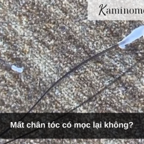 Mất chân tóc có mọc lại không?