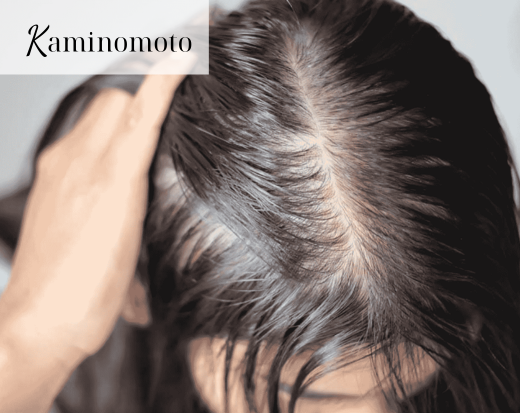 Chữa hói đầu nữ giới