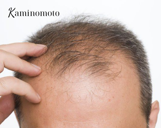 Trị rụng tóc nam giới