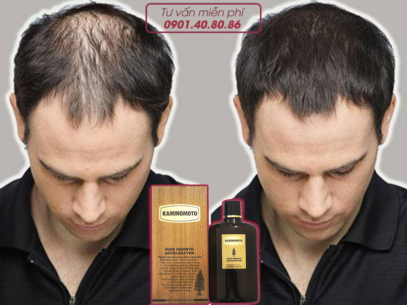 Vì sao da đầu nam giới thường tiết ra nhiều dầu nhờn